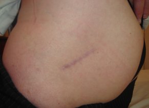 cicatrice après chirurgie mini-invasive Hanche